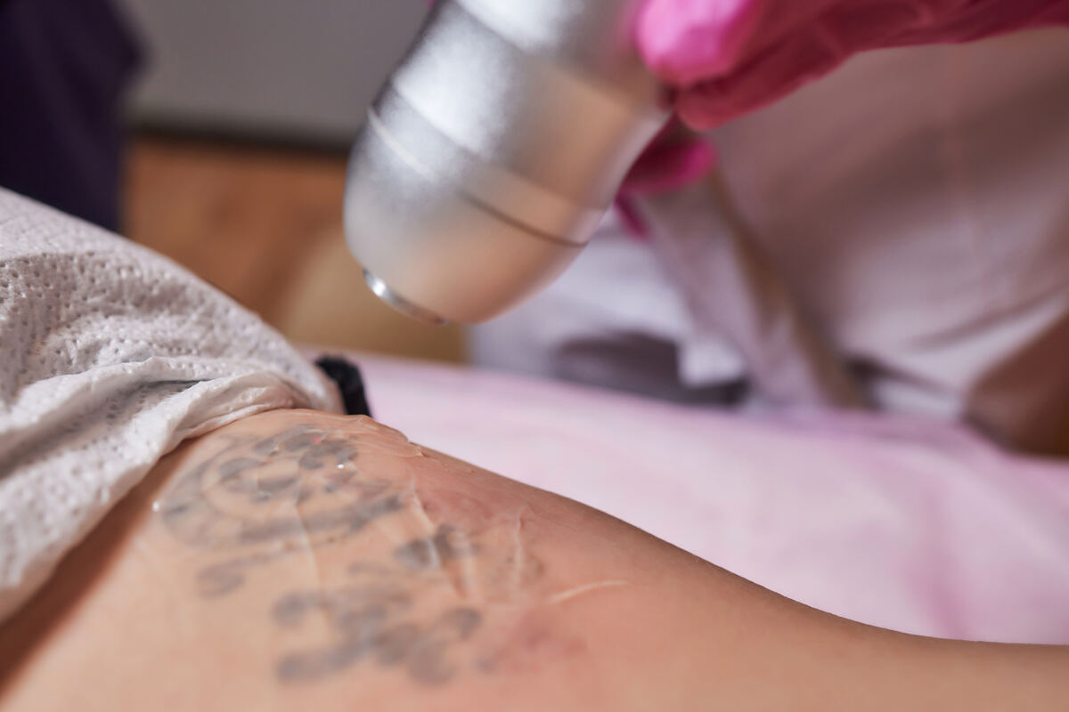 Remoção de tatuagem